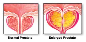 Enlarged Prostate